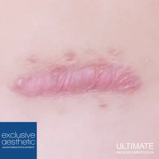 What Is Keloid Scarring And Can It Be Treated With Micropigmentation? Micropigmentation is a promising alternative for treating keloid scarring.